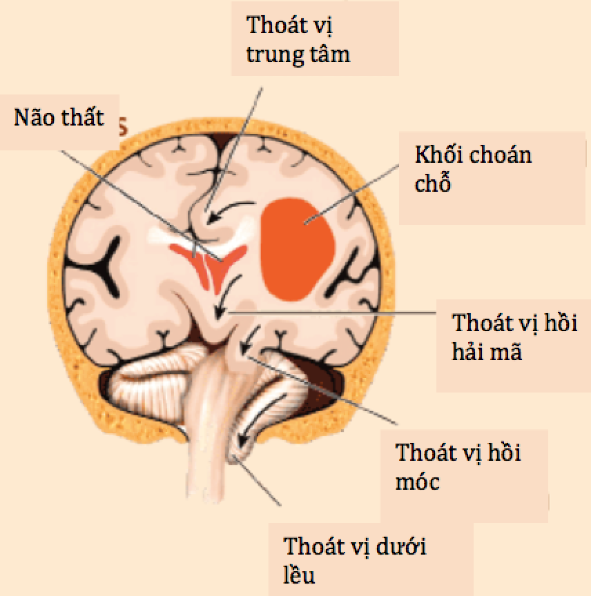 Ảnh 2 của Cerebral venous thrombosis